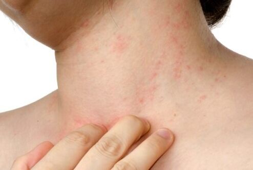 αλλεργία με υποδόρια παράσιτα